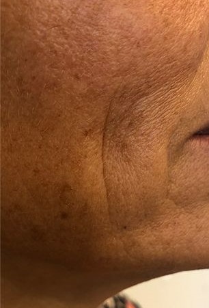 el antes de un tratamiento facial de ondas de choque para la flacidez, tratamiento antiedad sin cirugía.