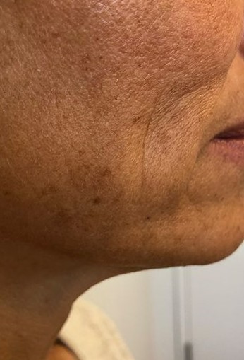 resultado de un tratamiento facial de ondas de choque para la flacidez, tratamiento antiedad sin cirugía.