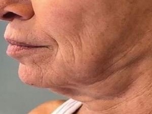 el antes de un tratamiento facial de ondas de choque para la flacidez, tratamiento antiedad sin cirugía.