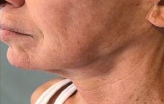 resultado de un tratamiento facial de ondas de choque para la flacidez, tratamiento antiedad sin cirugía.
