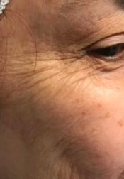 el antes de un tratamiento facial de coolifting para las arrugas