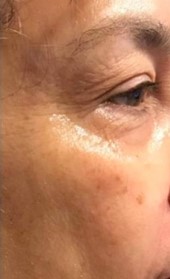 resultado de un tratamiento facial de coolifting para las arrugas