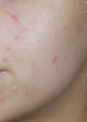 el antes de un tratamiento facial de dermapen para las cicatrices y marcas faciales, tratamiento antiedad sin cirugía.