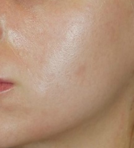 resultado de un tratamiento facial de dermapen para las cicatrices y marcas faciales. tratamiento antiedad sin cirugía.