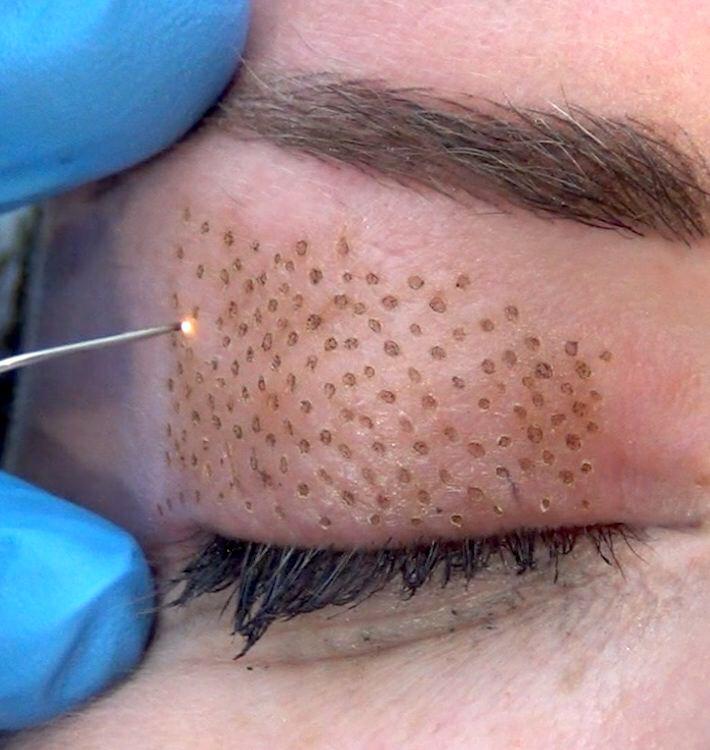 procedimiento de plasma pen para el tratamiento de las arrugas y los pliegues faciales