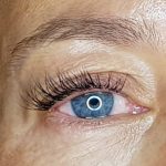 resultado de un tratamiento facial de plasma pen para los párpados caídos por la edad, tratamiento antiedad sin cirugía.