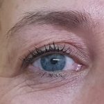 el antes de un tratamiento facial de plasma pen para los párpados caídos por la edad, tratamiento antiedad sin cirugía.