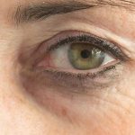el antes de un tratamiento facial de plasma pen para los párpados caídos por la edad, tratamiento antiedad sin cirugía.