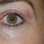resultado de un tratamiento facial de plasma pen para los párpados caídos por la edad, tratamiento antiedad sin cirugía.